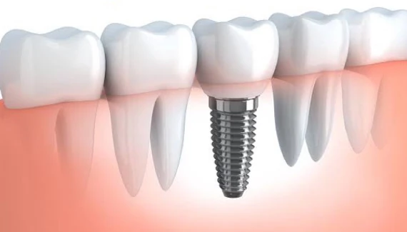 ทันตกรรมรากเทียม