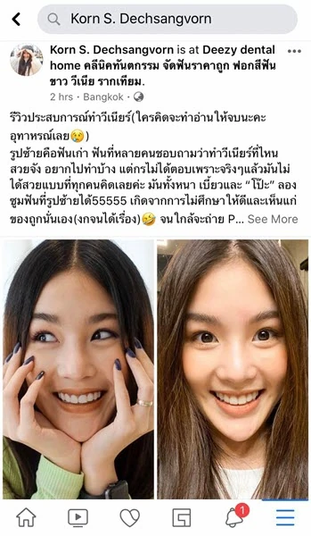 จัดฟันขอนแก่น, จัดฟันอุดรธานี, จัดฟันอุบลราชธานี รีวิว 1