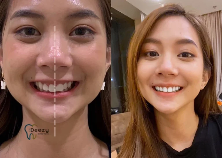 จัดฟันขอนแก่น, จัดฟันอุดรธานี, จัดฟันอุบลราชธานี รีวิว 2