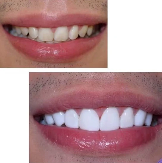 จัดฟันขอนแก่น, จัดฟันอุดรธานี, จัดฟันอุบลราชธานี รีวิว 6