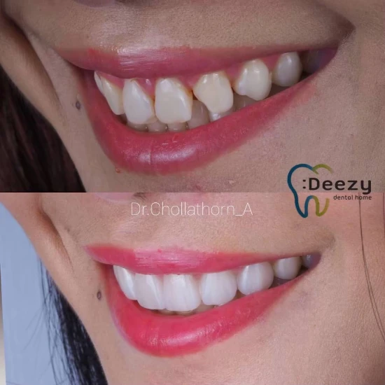 จัดฟันขอนแก่น, จัดฟันอุดรธานี, จัดฟันอุบลราชธานี รีวิว 14