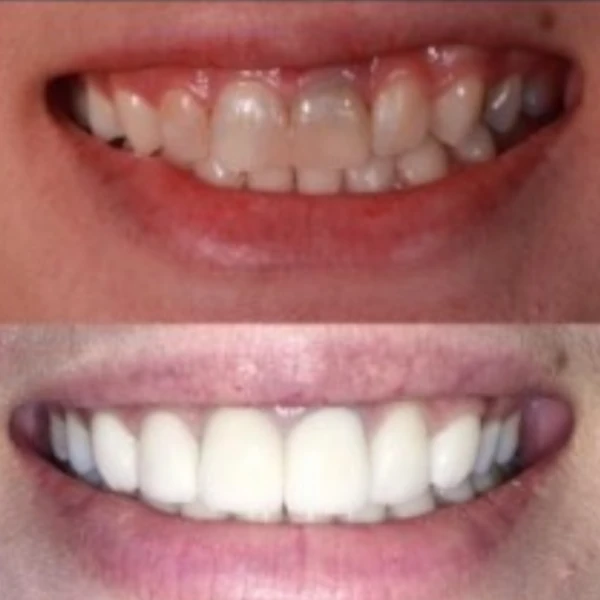 จัดฟันขอนแก่น, จัดฟันอุดรธานี, จัดฟันอุบลราชธานี รีวิว 15