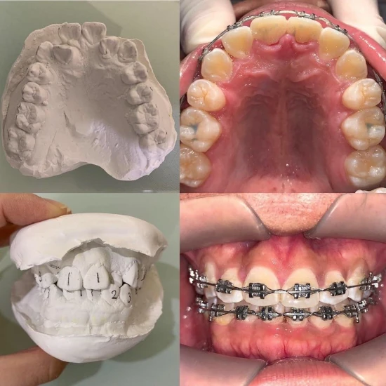 จัดฟันขอนแก่น, จัดฟันอุดรธานี, จัดฟันอุบลราชธานี  รีวิว 4