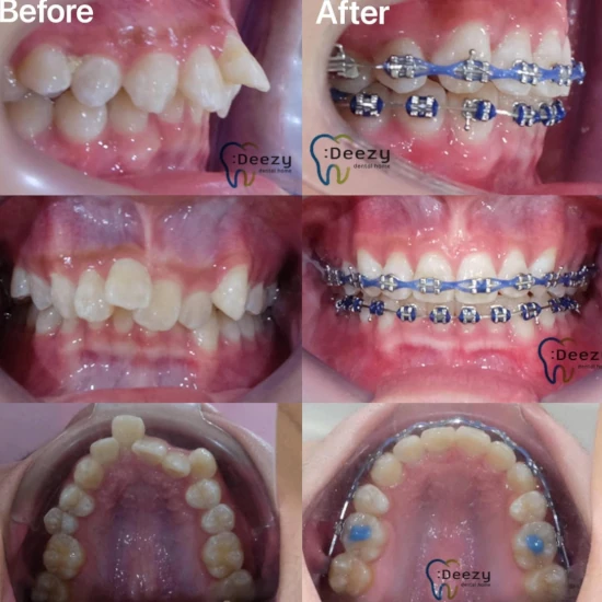 จัดฟันขอนแก่น, จัดฟันอุดรธานี, จัดฟันอุบลราชธานี  รีวิว 6