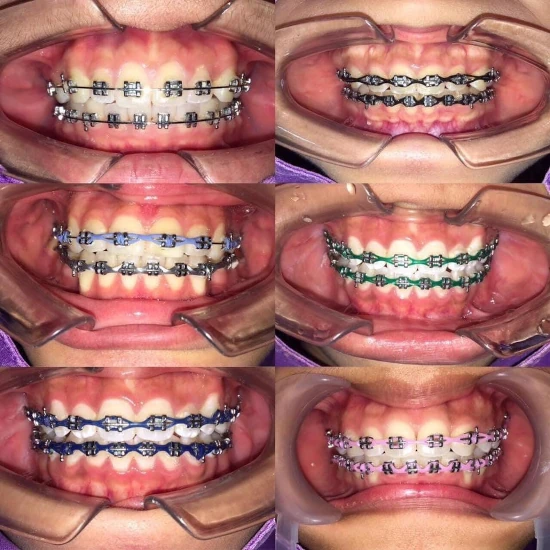 จัดฟันขอนแก่น, จัดฟันอุดรธานี, จัดฟันอุบลราชธานี  รีวิว 14