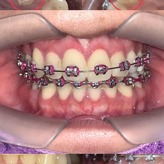 จัดฟันขอนแก่น, จัดฟันอุดรธานี, จัดฟันอุบลราชธานี  รีวิว 16