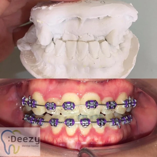 จัดฟันขอนแก่น, จัดฟันอุดรธานี, จัดฟันอุบลราชธานี  รีวิว 19