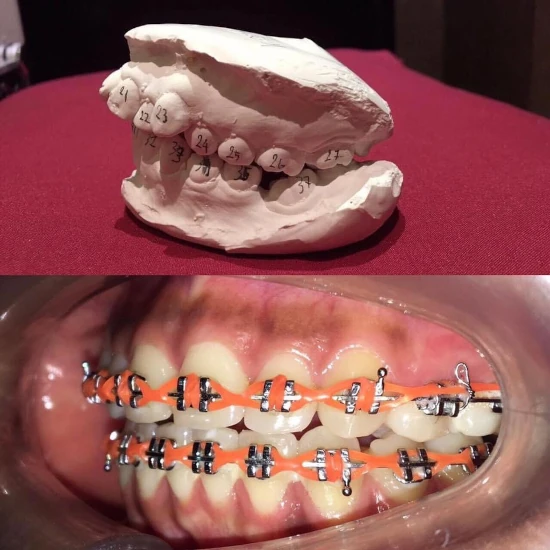 จัดฟันขอนแก่น, จัดฟันอุดรธานี, จัดฟันอุบลราชธานี  รีวิว 20