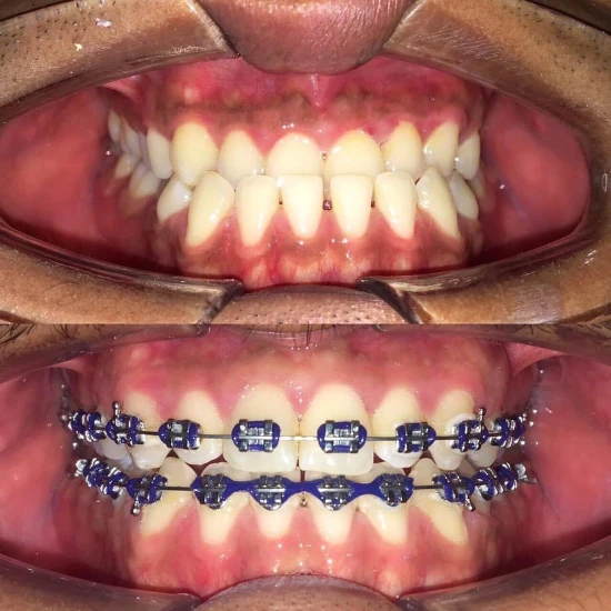 จัดฟันขอนแก่น, จัดฟันอุดรธานี, จัดฟันอุบลราชธานี  รีวิว 21