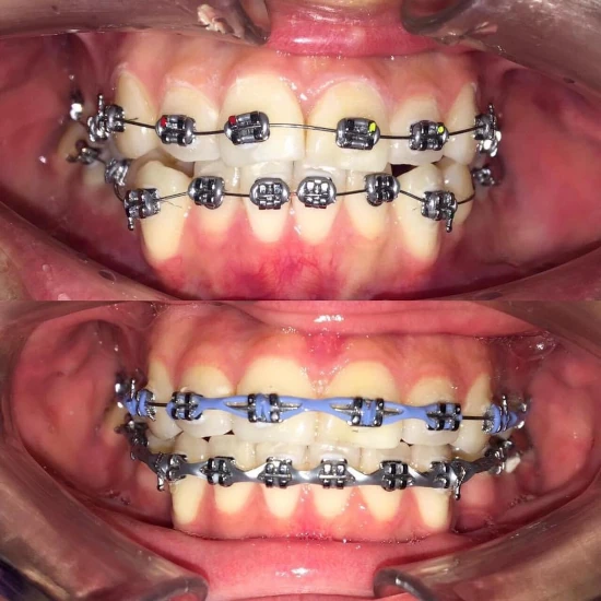 จัดฟันขอนแก่น, จัดฟันอุดรธานี, จัดฟันอุบลราชธานี  รีวิว 23