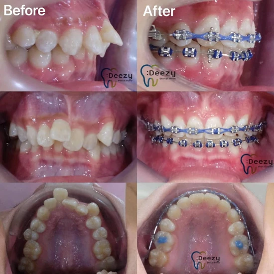 จัดฟันขอนแก่น, จัดฟันอุดรธานี, จัดฟันอุบลราชธานี  รีวิว 24