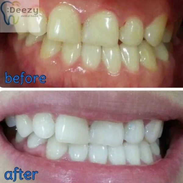 จัดฟันขอนแก่น, จัดฟันอุดรธานี, จัดฟันอุบลราชธานี รีวิว 1