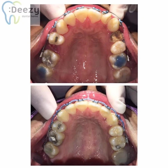 รีวิวจัดฟันใส
