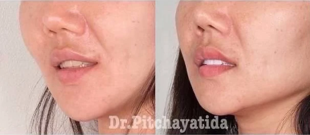 รีวิววีเนียร์แปะฟันขาว