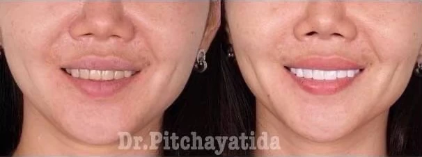 รีวิววีเนียร์แปะฟันขาว