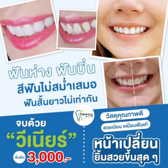 รีวิววีเนียร์แปะฟันขาว