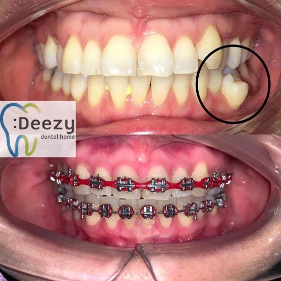 รีวิวจัดฟันใส