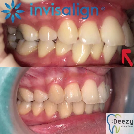 รีวิวจัดฟันใส