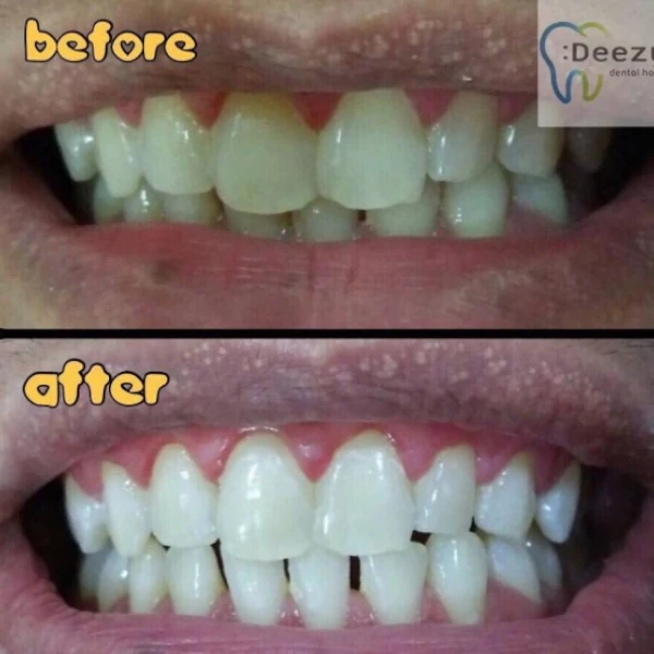 รีวิวฟอกสีฟันขาว