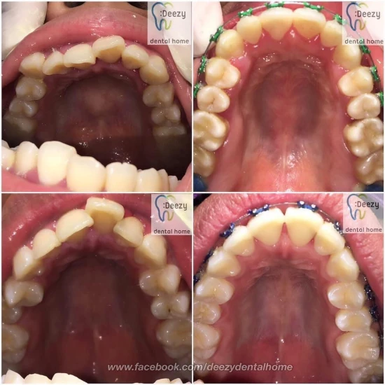 รีวิวจัดฟันใส