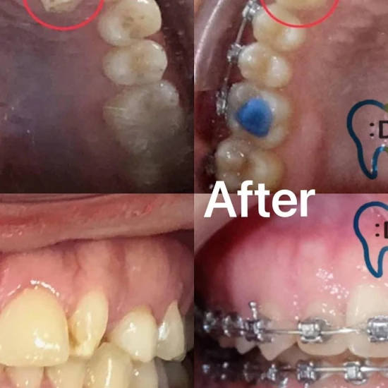 รีวิวจัดฟันใส