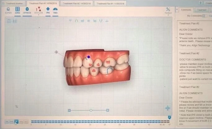 รีวิวจัดฟันใส