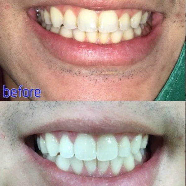 รีวิวฟอกสีฟันขาว