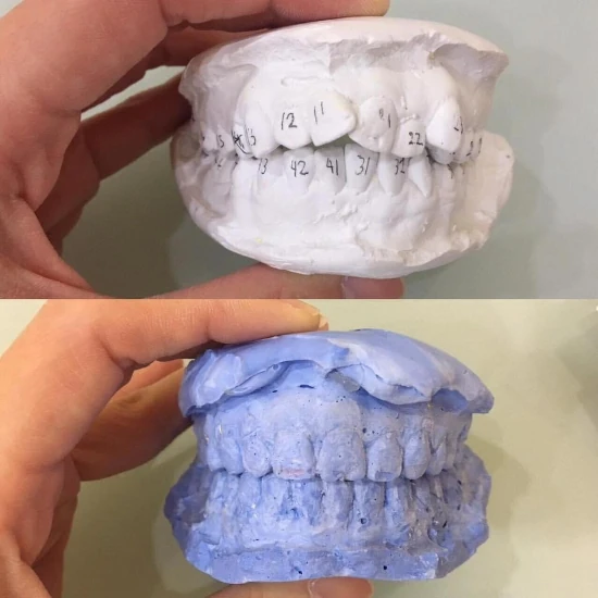 รีวิวจัดฟันใส