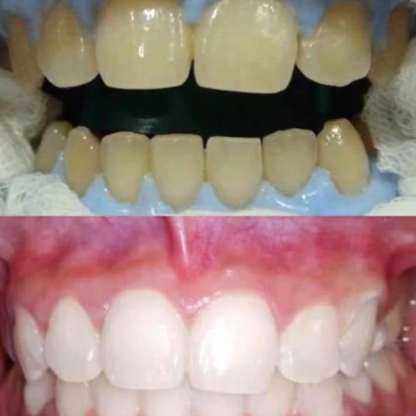 รีวิวฟอกสีฟันขาว