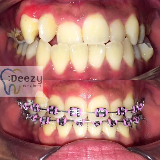 รีวิวจัดฟันใส