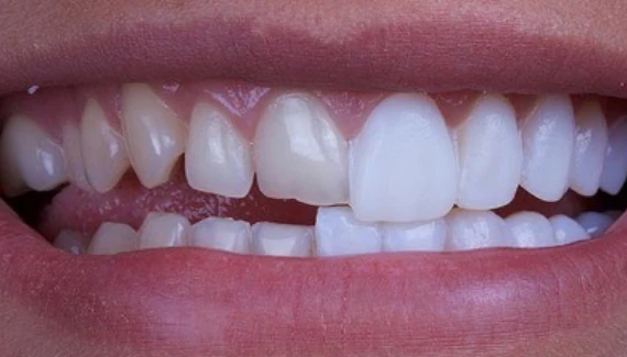 ค่าบริการรักษาฟันรายการพิเศษ ขอนแก่น อุดรธานี อุบลราชธานี